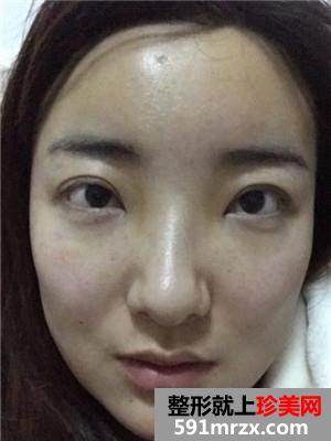 面部吸脂瘦脸术恢复过程和前后对比照分享