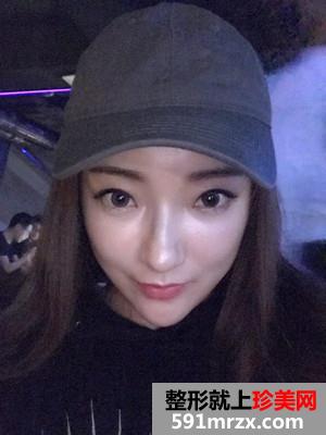 面部吸脂瘦脸术恢复过程和前后对比照分享