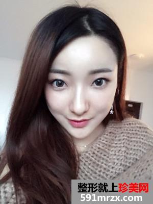 面部吸脂瘦脸术恢复过程和前后对比照分享
