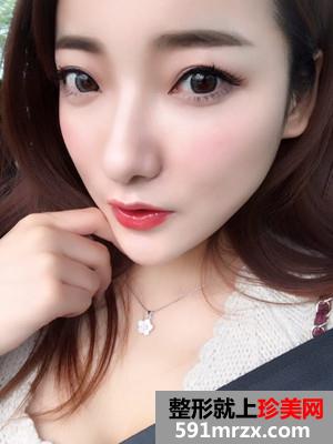 面部吸脂瘦脸术恢复过程和前后对比照分享