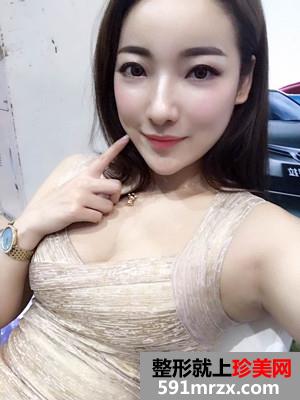 面部吸脂瘦脸术恢复过程和前后对比照分享