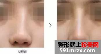 长沙整形医院做隆鼻失败修复多少钱