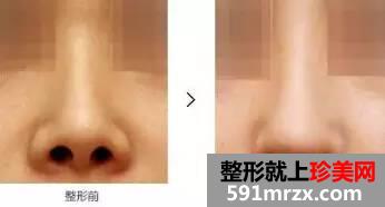 长沙整形医院做隆鼻失败修复多少钱