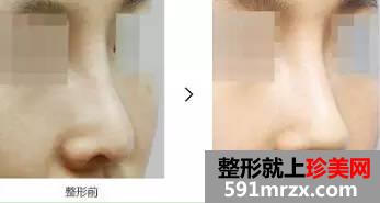 长沙整形医院做隆鼻失败修复多少钱
