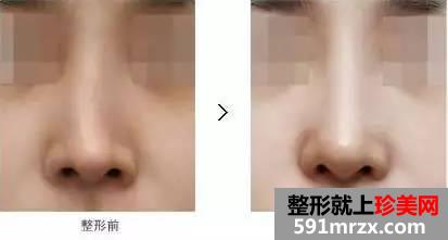长沙整形医院做隆鼻失败修复多少钱