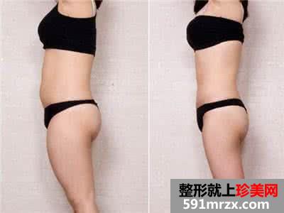武汉做全身吸脂手术多少钱