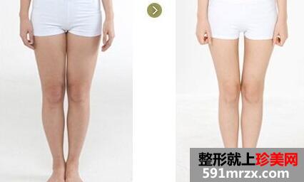 成都整形医院做腿部吸脂的价格是多少