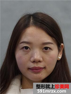 全切双眼皮+开眼角手术前后恢复对比图和案例分享