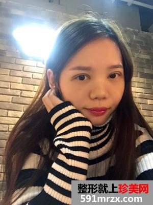 全切双眼皮+开眼角手术前后恢复对比图和案例分享