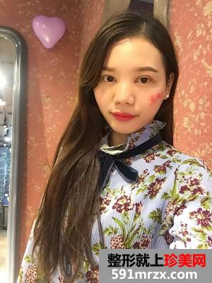 全切双眼皮+开眼角手术前后恢复对比图和案例分享