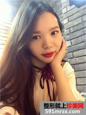 全切双眼皮+开眼角手术前后恢复对比图和案例分享