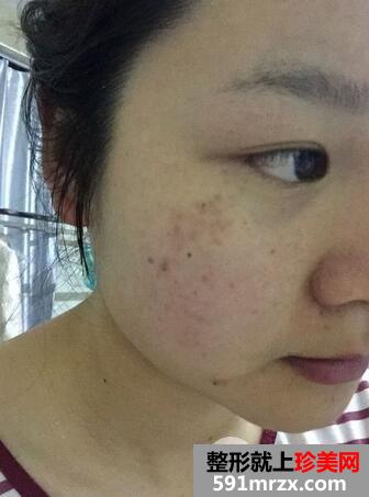 去黄褐斑的价格1