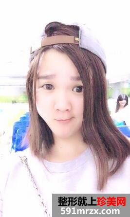 去黄褐斑的价格8