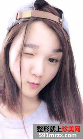 去黄褐斑的价格9