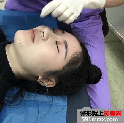 丰唇术的价格2