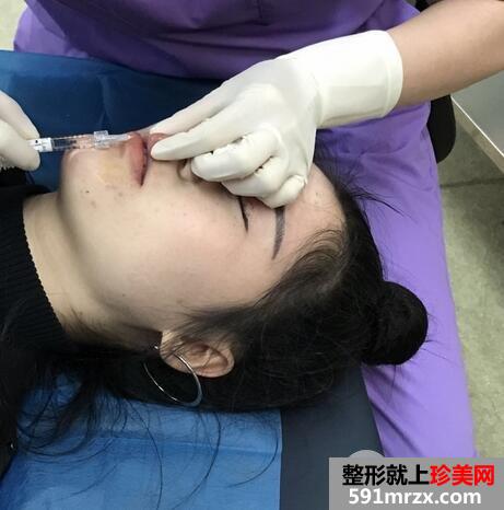 丰唇术的价格4