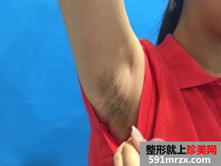 全身脱毛要多少钱1