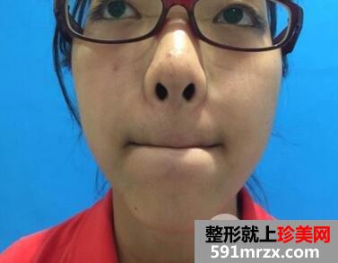 全身脱毛要多少钱2