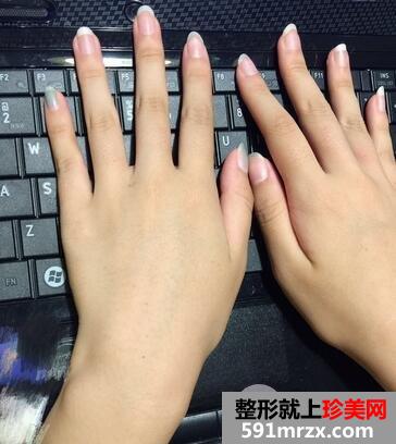 全身脱毛要多少钱10
