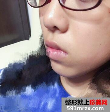全身脱毛要多少钱11
