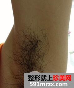 腋下脱毛费用1