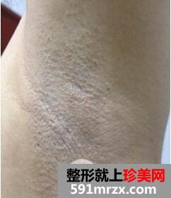 腋下脱毛费用2