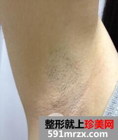 腋下脱毛费用3