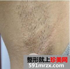 腋下脱毛费用5
