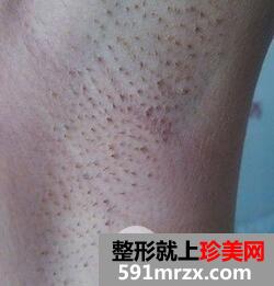 腋下脱毛费用6