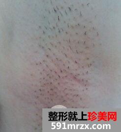 腋下脱毛费用7