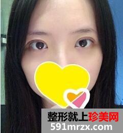 双眼皮手术3