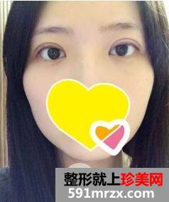双眼皮手术4