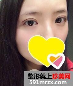 双眼皮手术5