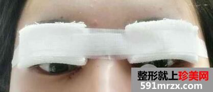 韩式开内眼角多少钱2