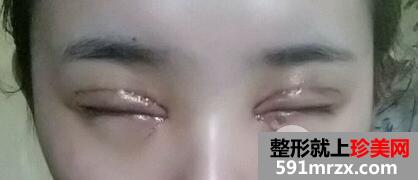韩式开内眼角多少钱4