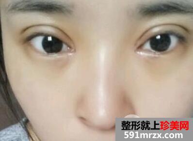 韩式开内眼角多少钱6