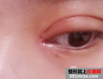 韩式开内眼角多少钱7