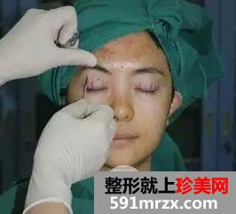真人案例：小眯眯眼也可以完成大逆袭！