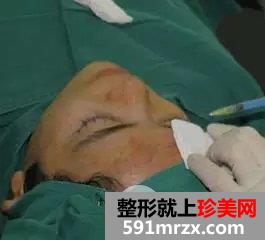 真人案例：小眯眯眼也可以完成大逆袭！