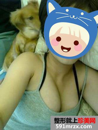 假体隆胸前后效果对比图