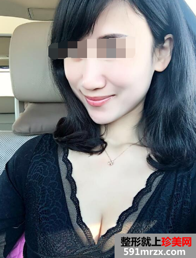 网友,分享,自体脂肪,移植,丰胸,手术,体会