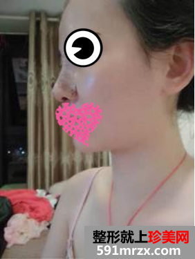 膨体隆鼻真人案例对比图