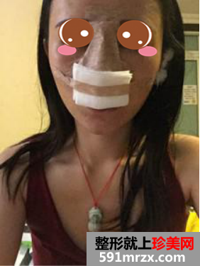 膨体隆鼻真人案例对比图