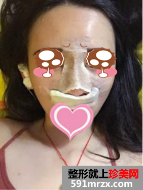 膨体隆鼻真人案例对比图