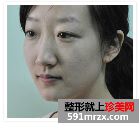 北京,明会红,国际,医疗,美容,机构,隆鼻,去眼袋,从平凡到惊艳