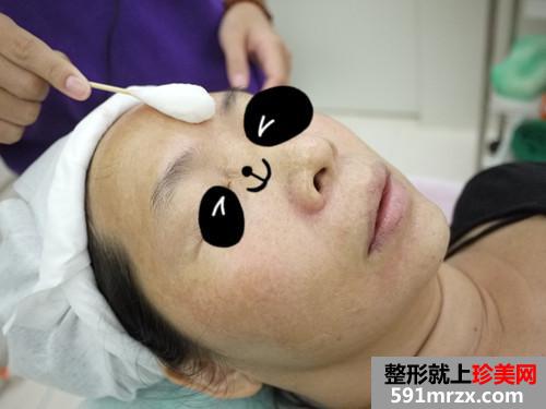 金华华美整形医院的埋线提拉 还我10年青春