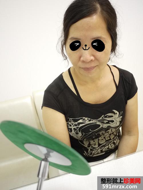 金华华美整形医院的埋线提拉 还我10年青春