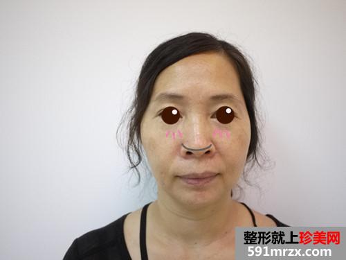 金华华美整形医院的埋线提拉 还我10年青春