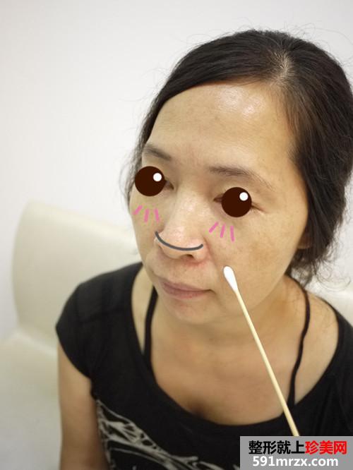 金华华美整形医院的埋线提拉 还我10年青春