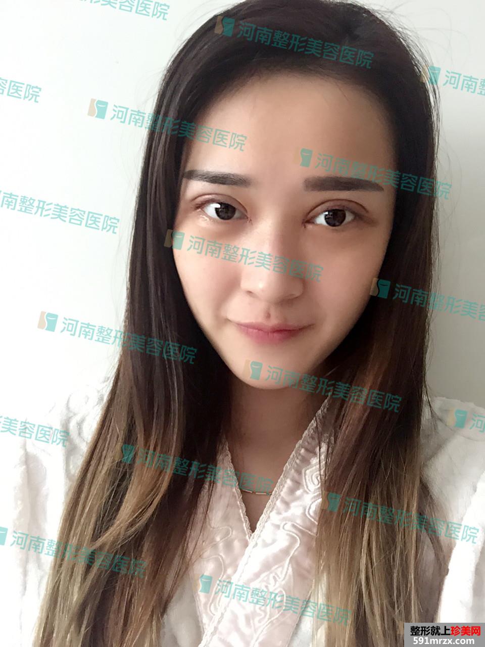 郑州,整形,切开法,平扇,双眼皮,恢复,过程,美图,来袭